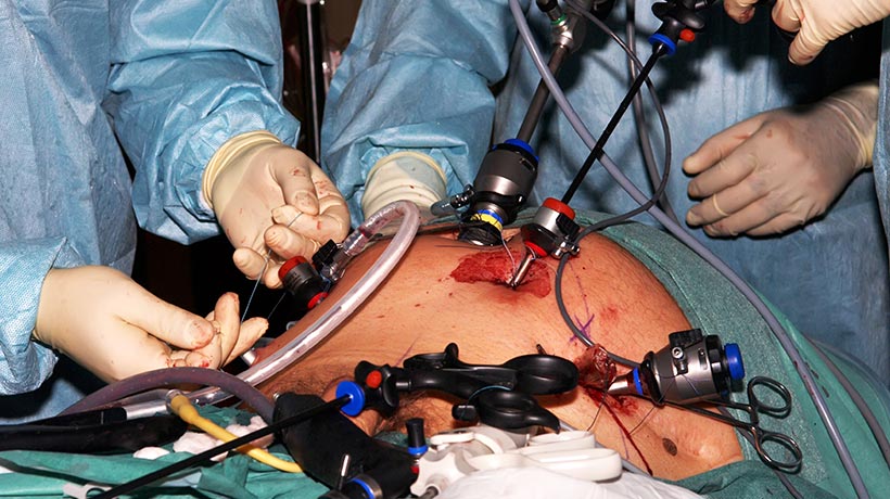 Obesity Surgery in pune